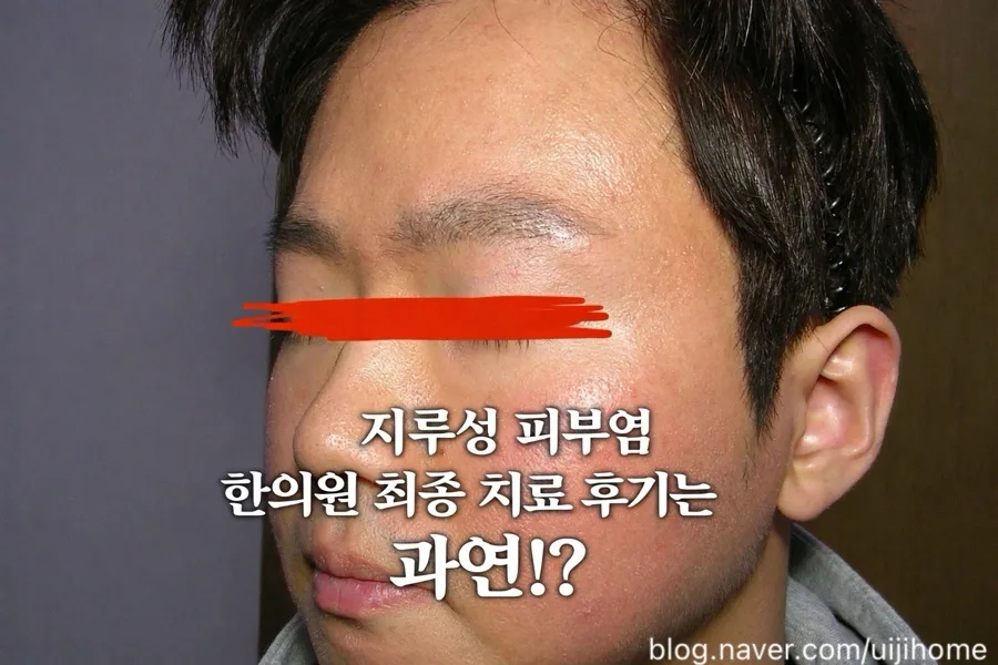 지루성 피부염 한의원 치료 9개월 후기: 증상 변화와 솔직한 경험 2026