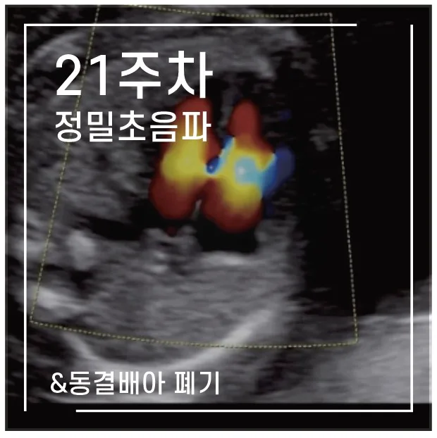 임신 21주차 정밀초음파 후기: 태아 건강과 동결배아 결정 2026