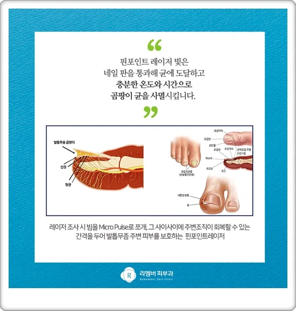 발톱 무좀 치료, 2026년 시작해야 하는 이유와 방법 총정리