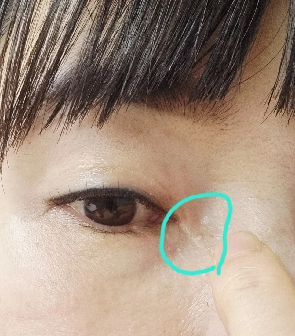 눈가 비립종 제거 2026: 관저동 피부과 경험자 후기 및 비용