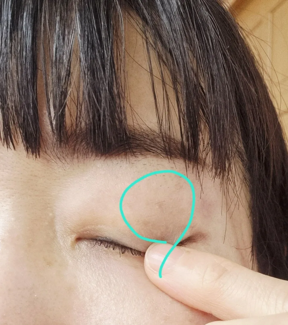 눈가 비립종 제거 2026: 관저동 피부과 경험자 후기 및 비용 2