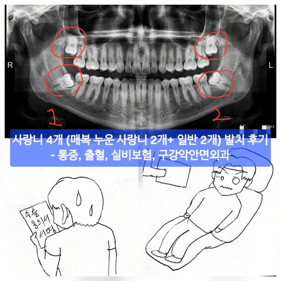 사랑니 발치 후기 2026: 통증, 출혈, 실비보험 보장까지 총정리