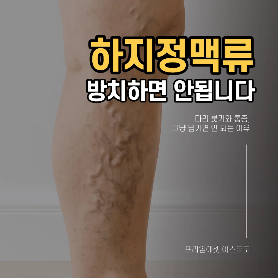 하지정맥류 방치 시 위험성 2026: 증상, 원인, 예방 총정리