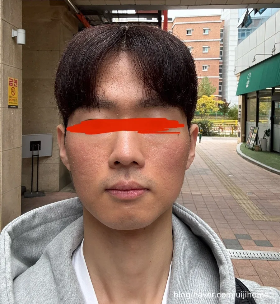 청주 S의원 피코슈어토닝 2회차 후기 (2026년 최신 정보)