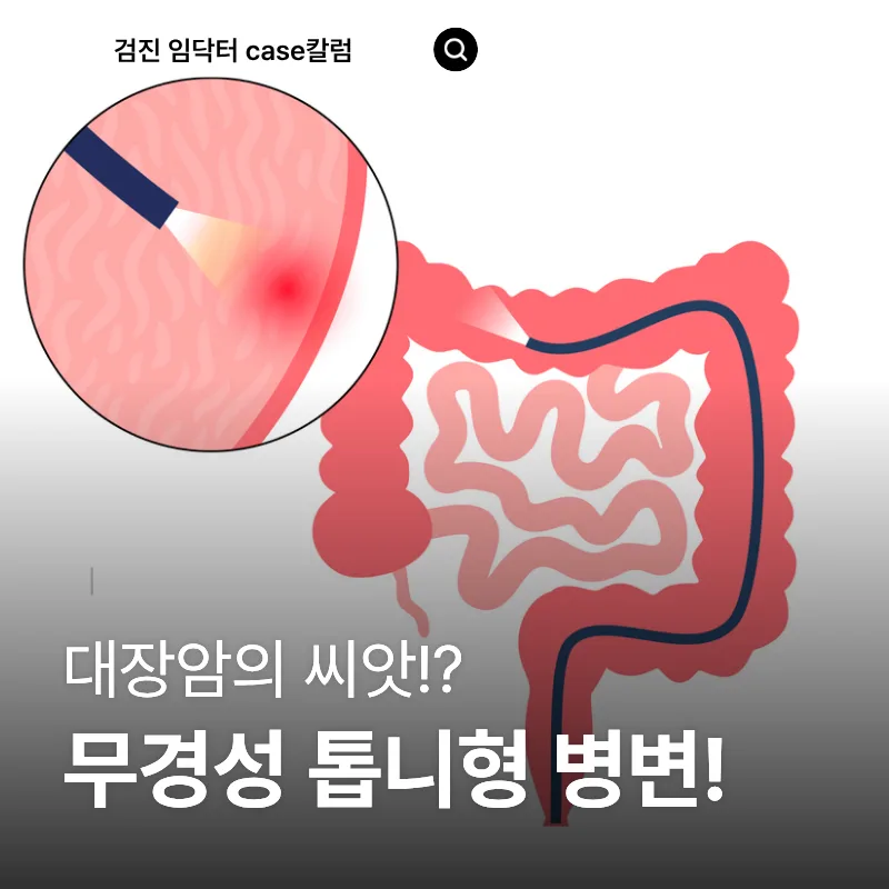 무경성 톱니형 병변이란? 대장내시경 조직검사 결과 2026년 총정리