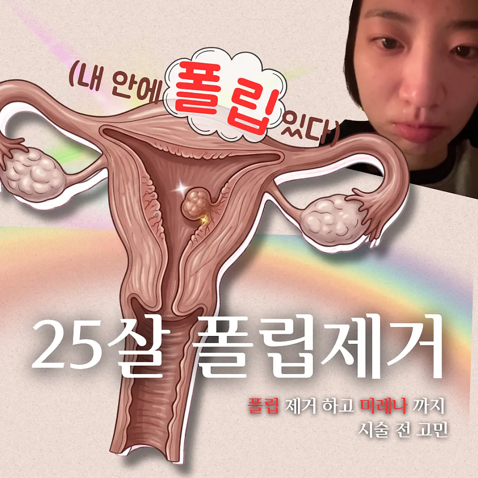 자궁 폴립 제거 및 미레나 시술 후기 (2026년 최신 정보)