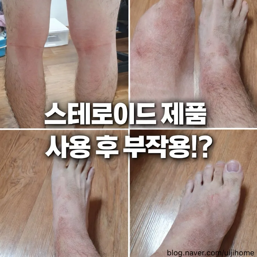 스테로이드 중단 부작용 경험기: 피부과 vs 한의원 치료 비교 2026