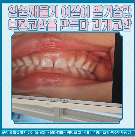 6세 유아 부정교합 조기 진단 및 교정 방법 2026