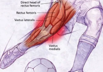 Quadriceps Tear Symptoms & Treatment Guide 2026