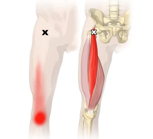 Quadriceps Tear Symptoms & Treatment Guide 2026 2