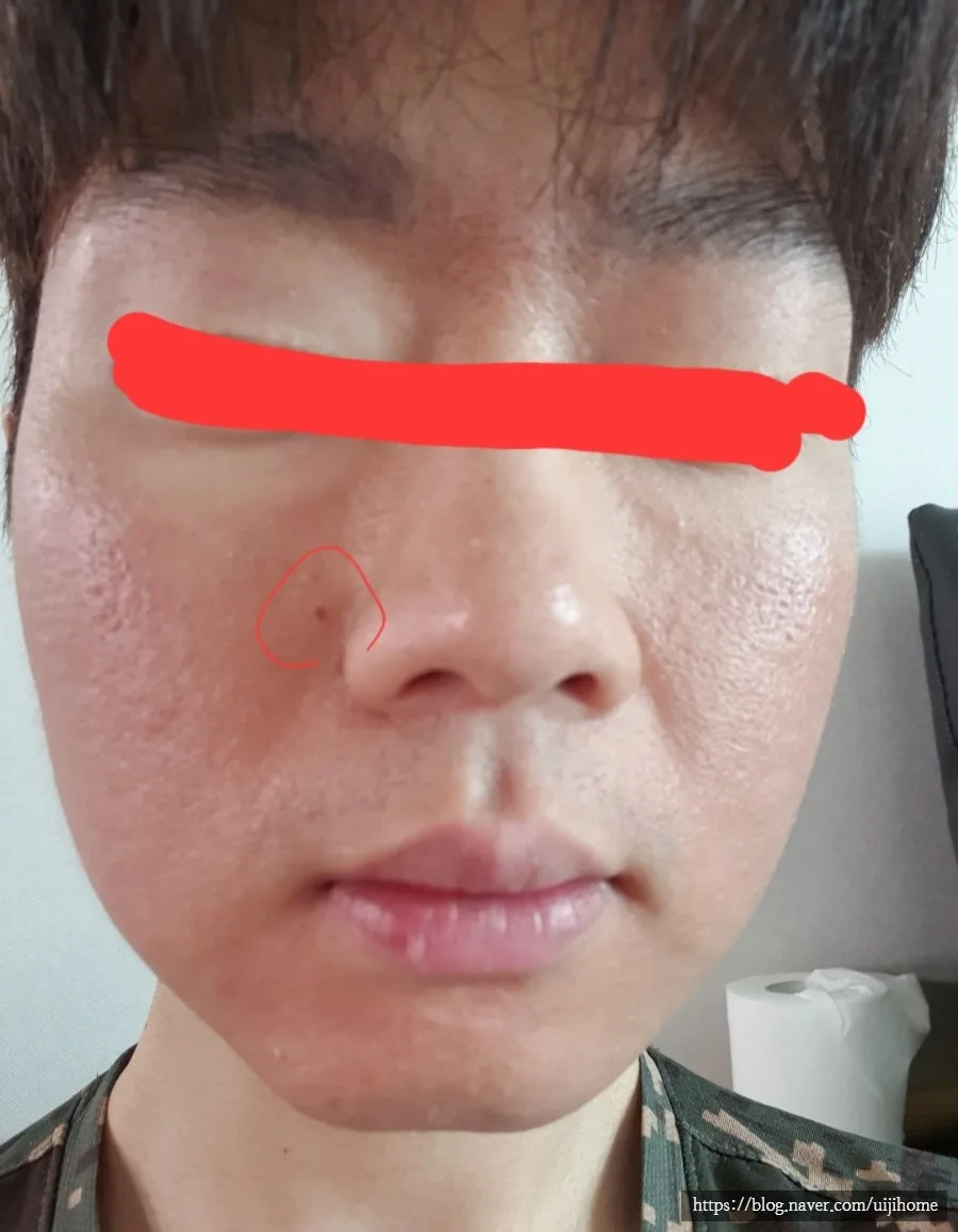 코 옆 점 제거 효과 2026: 통증, 흉터, 사후관리 완벽 정리 3