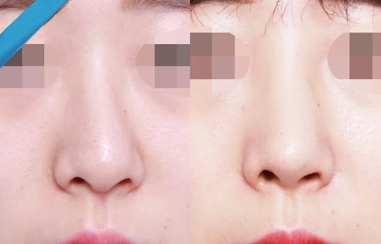 비중격만곡증 수술 비용과 보험 적용 2026년 총정리