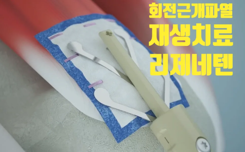 회전근개 파열 재파열 걱정 끝? 리제네텐 치료 2026년 총정리