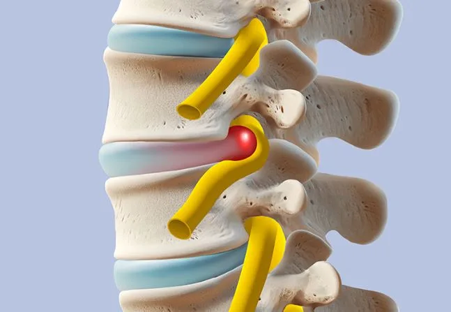 Herniated Disc Surgery Costs 2026: Average, By Type & Insurance