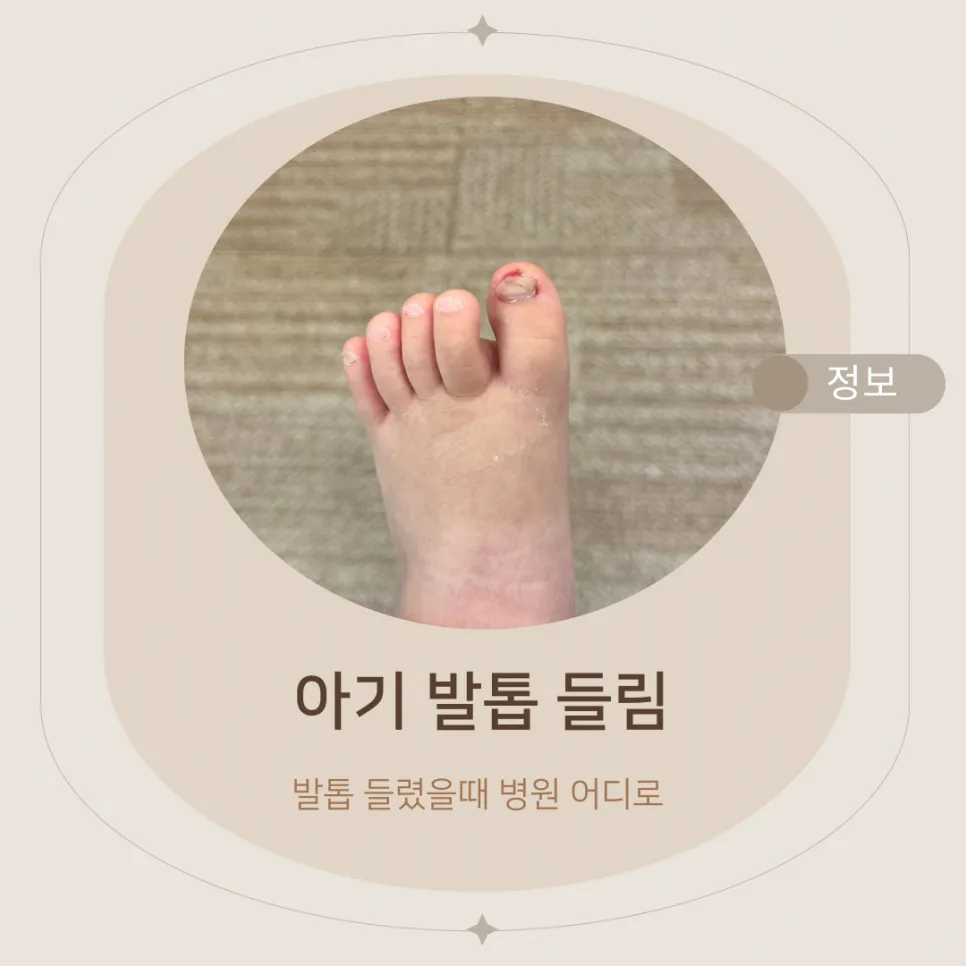 아기 발톱 들림 병원 어디로? 정형외과 치료 후기 2026
