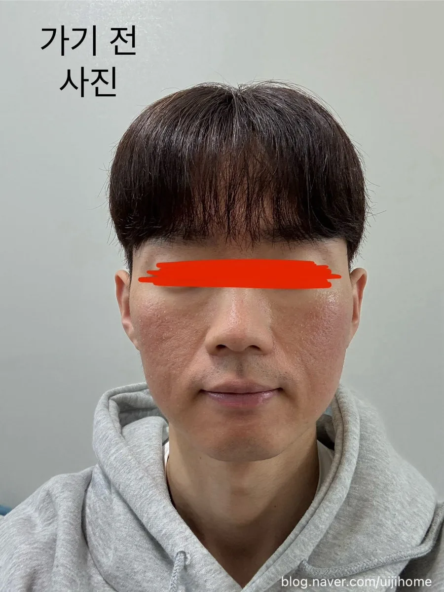 지루성 피부염 1회차 시술 후기: 피부과 레이저 효과 2026