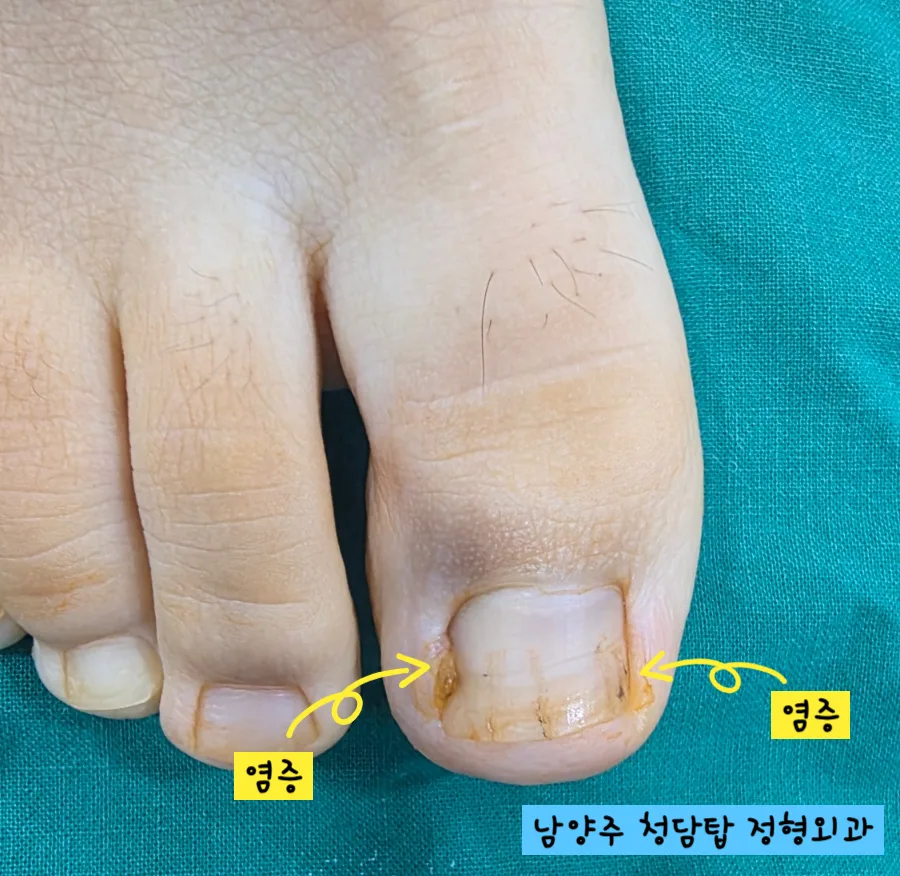 내성발톱 재발 없이 치료하는 병원 찾는 법 2026