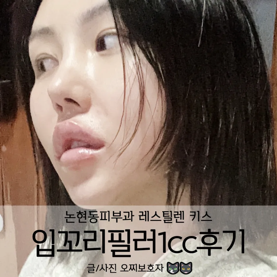 입술 필러 후기 2026: 논현동 입꼬리 필러 시술 경험 총정리