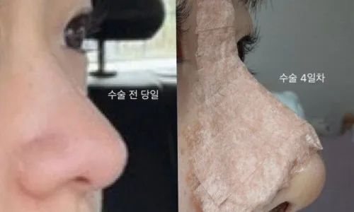 기능코 실비 환급 2026: 종합보험으로 100만원 미만 코성형 후기
