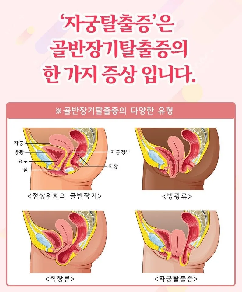 자궁탈출증 수술, 서울 병원 선택 가이드 2026 2
