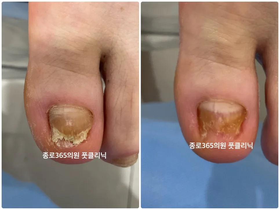 내성발톱과 발톱무좀 동시 교정 2026년 최신 치료법